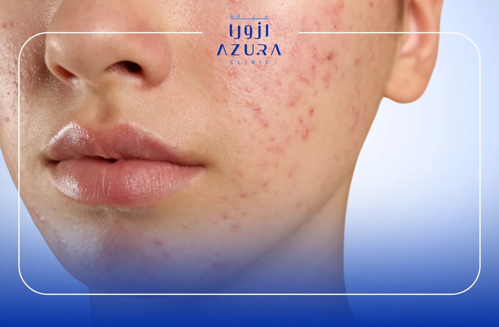 Active Acne